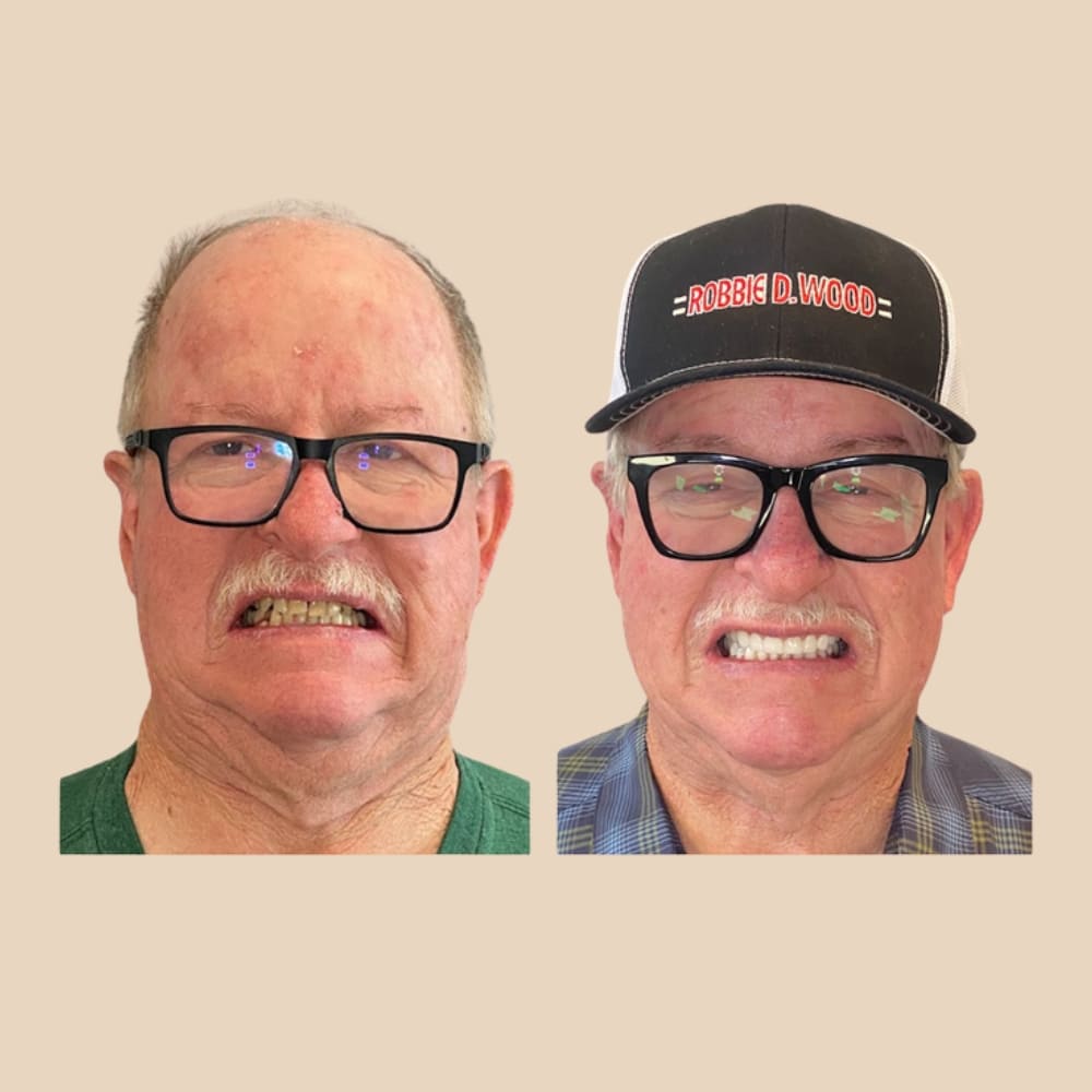 Dentier Premium ClairSourire™