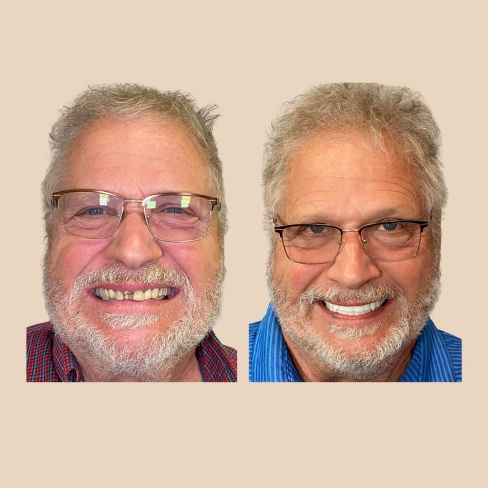 Dentier Premium ClairSourire™