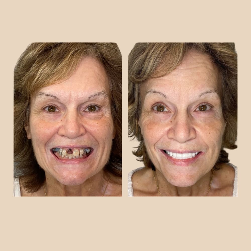 Dentier Premium ClairSourire™